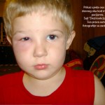 Prikaz ujeda ose ispod desnog obraza pacijenata starosti 11 godina.Klik na sliku za prikaz fotografije sa svim detaljima.