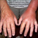 Ujed ose na levoj ruci koja je zahvacena infekcijom bez blagovremenog tretmana.Klik na sliku gore levim misem za prikaz u punoj velicini.